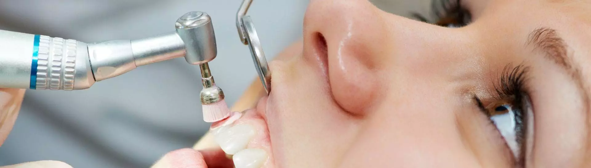 Teeth Cleaning in Kadapa Teeth Cleaning in Kadapa