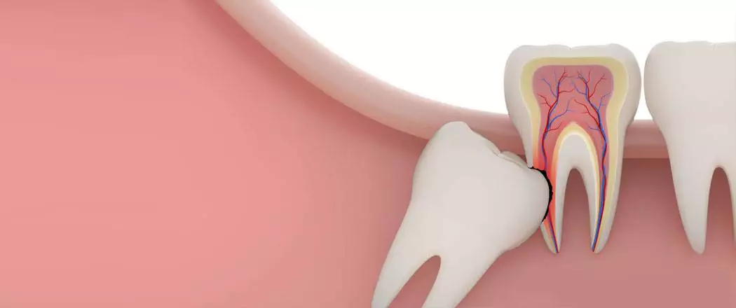 Wisdom Tooth Extraction in Kadapa Wisdom Tooth Extraction in Kadapa
