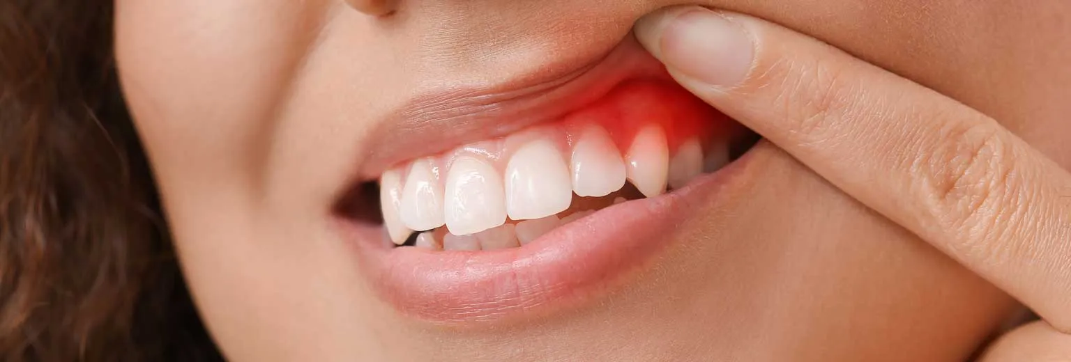 Gum Treatment in Kadapa Gum Treatment in Kadapa