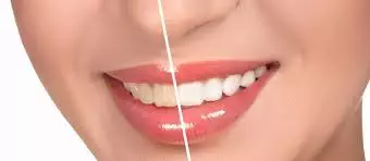 Teeth Whitening in Kadapa Teeth Whitening in Kadapa
